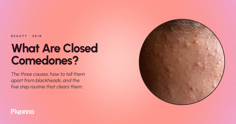 What Are Closed Comedones, and How Do You Actually Get Rid of Them?