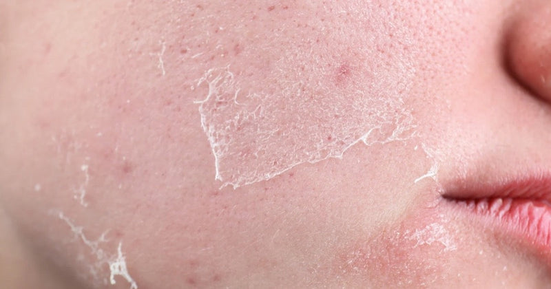 Is Your Skin Getting Drier and Rougher as Autumn Arrives? How to Choose the Right Moisturiser