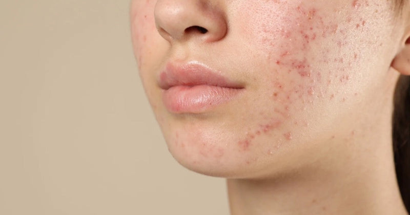 Blemishes Gone but the Redness Stayed? My Experience with a Madecassoside Serum