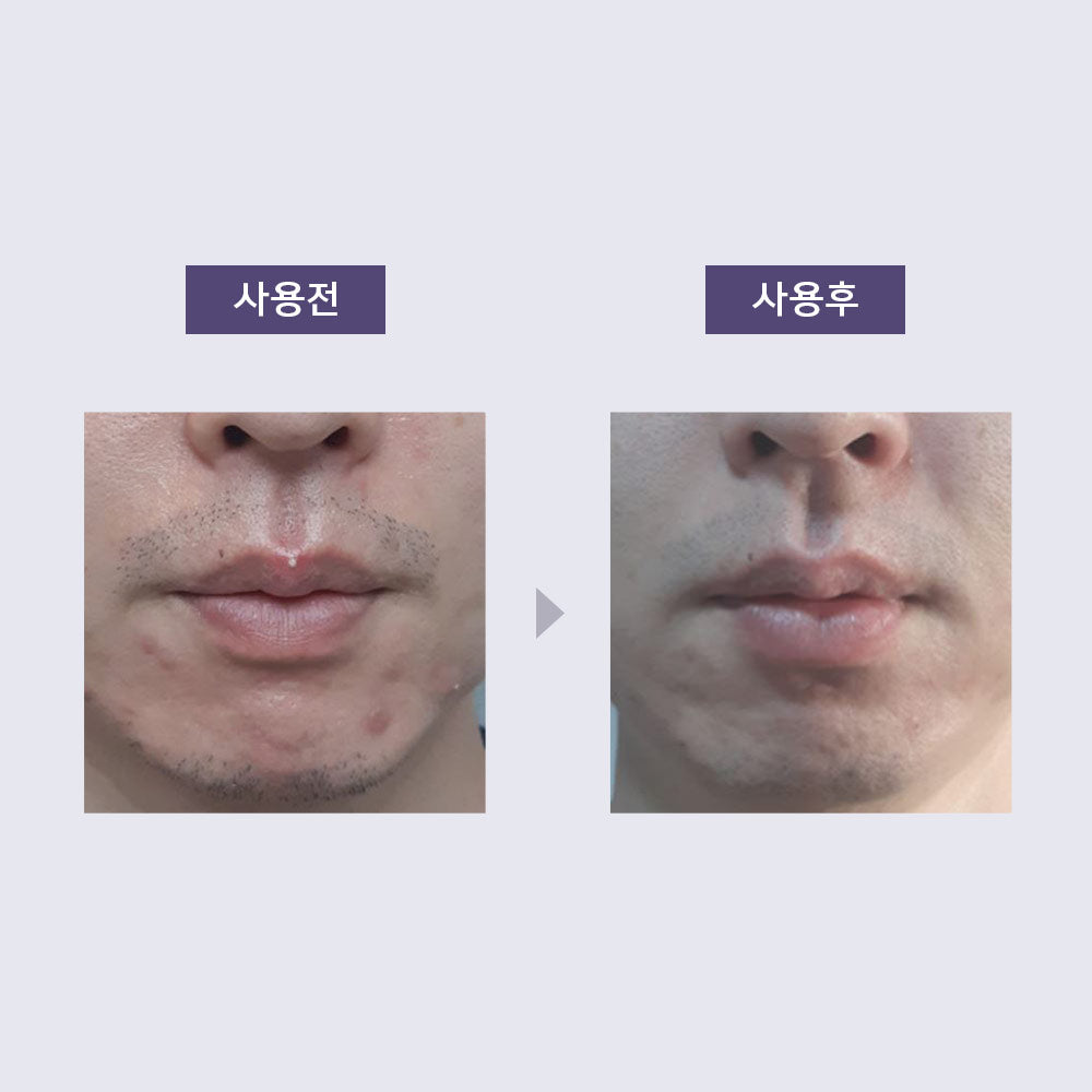 piyonna Acleon Acne Trouble Spot Cream Face Care Serum