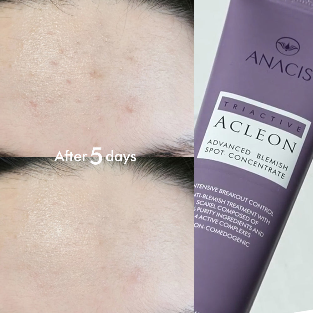 piyonna Acleon Acne Trouble Spot Cream Face Care Serum