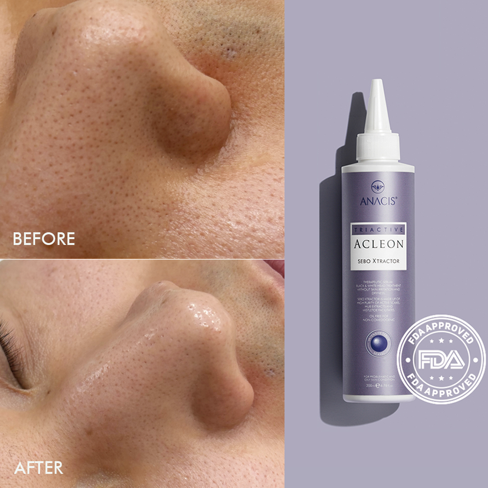 piyonna Acleon Blackhead Pore Sebum Softener Face Care Cleanser Exfoliator