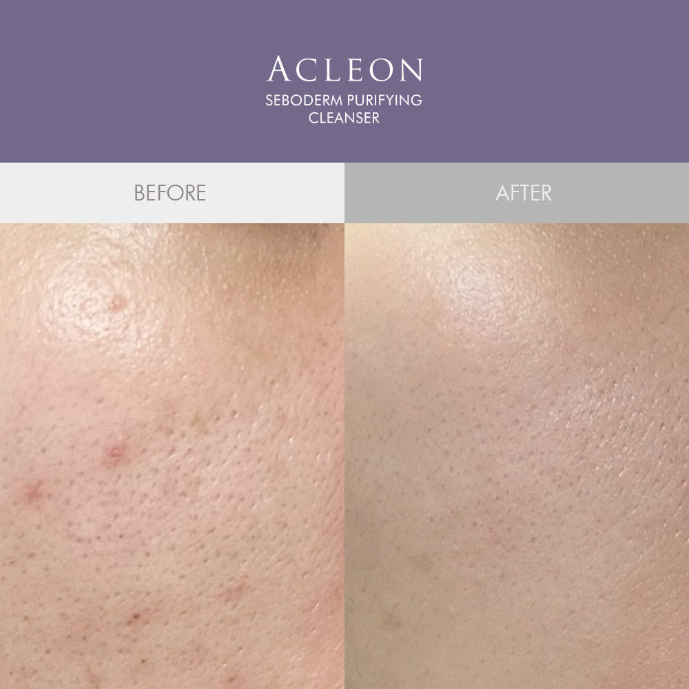 piyonna Acleon Oily Skin Salicylic Acid Cleansing Foam 200ml Face Care Cleanser Cleansing Foam